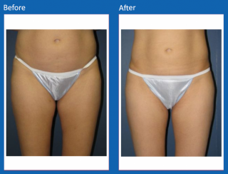liposuction-22