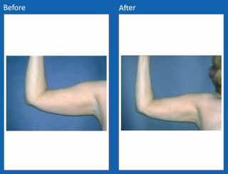 liposuction-3