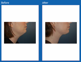 liposuction-4