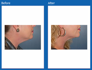 liposuction-5
