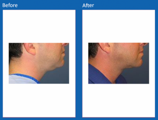 liposuction-6