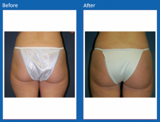 liposuction-7