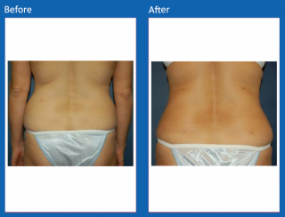 liposuction-8
