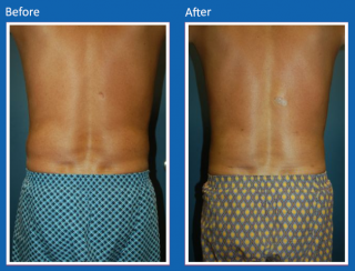 liposuction-9