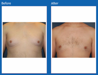 male-breast-surgery-1