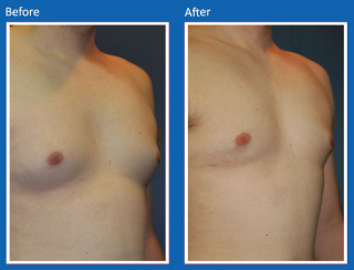 male-breast-surgery-2