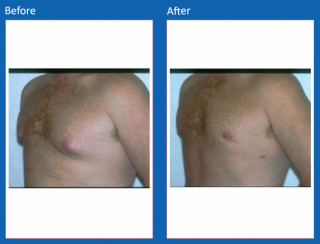 male-breast-surgery-3