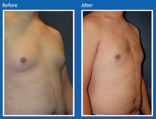 male-breast-surgery-4