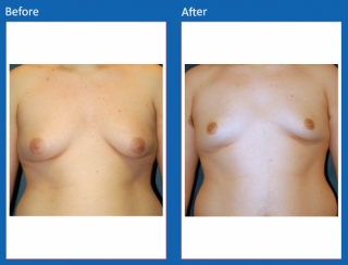 male-breast-surgery-5