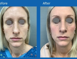 Rhinoplasty