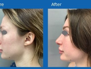 Rhinoplasty1