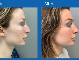 Rhinoplasty2