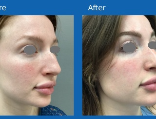 Rhinoplasty3