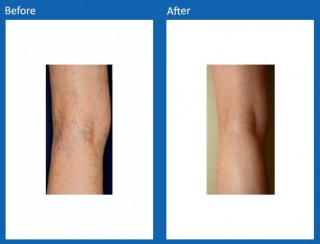 Sclerotherapy-Before-and-After-1