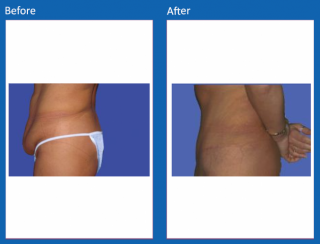 tummy-tuck-1