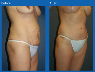 tummy-tuck-10