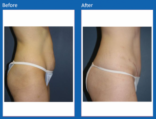 tummy-tuck-11
