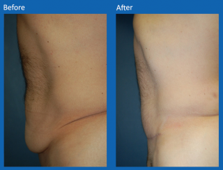 tummy-tuck-12