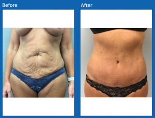tummy-tuck-13