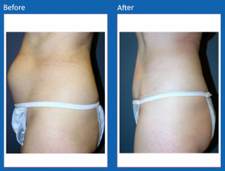 tummy-tuck-14