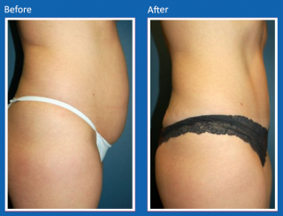 tummy-tuck-15