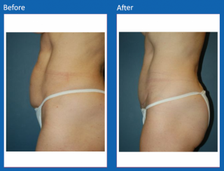tummy-tuck-16