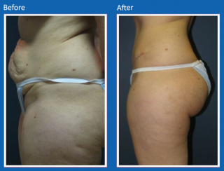 tummy-tuck-17