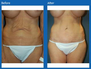 tummy-tuck-18