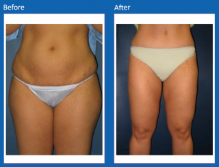 tummy-tuck-19