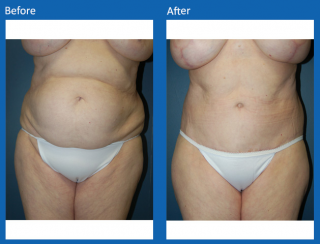 tummy-tuck-2