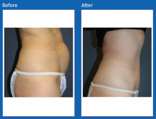 tummy-tuck-21