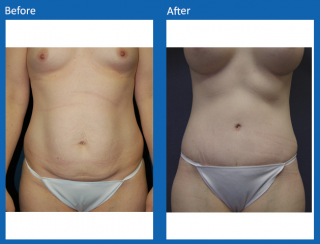 tummy-tuck-22