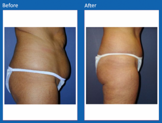 tummy-tuck-23