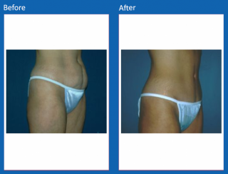 tummy-tuck-24