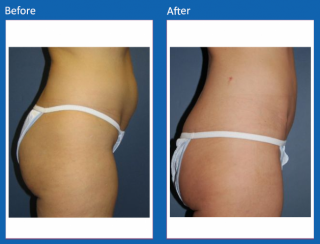 tummy-tuck-26