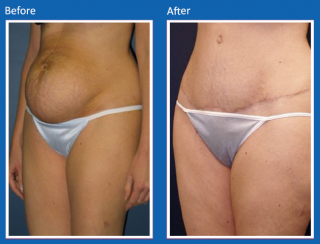 tummy-tuck-27