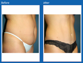 tummy-tuck-28