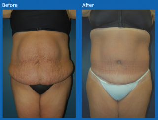 tummy-tuck-29