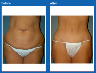 tummy-tuck-3