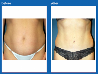 tummy-tuck-30