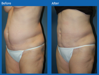 tummy-tuck-31