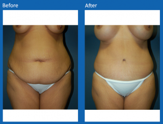 tummy-tuck-32