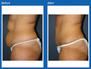 tummy-tuck-33