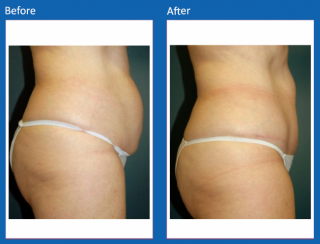 tummy-tuck-34