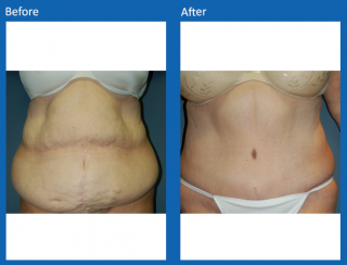 tummy-tuck-35