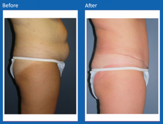 tummy-tuck-36
