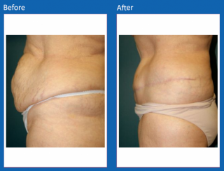 tummy-tuck-37