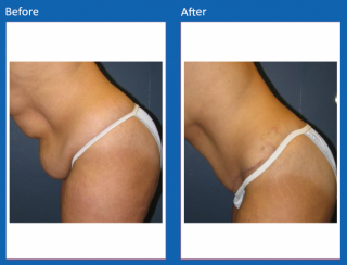 tummy-tuck-38