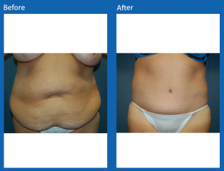 tummy-tuck-39