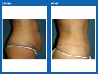 tummy-tuck-4